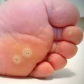 Can You Heal Faster? Stages of Wart Healing After Freezing Tips