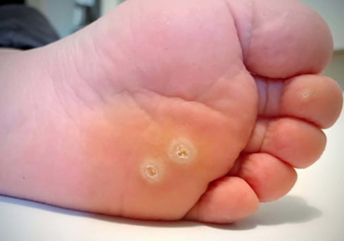 Can You Heal Faster? Stages of Wart Healing After Freezing Tips